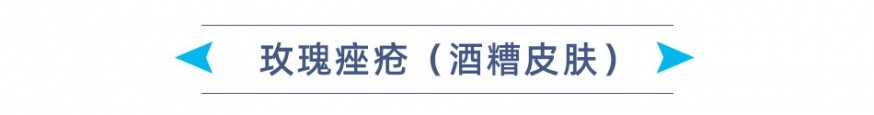 玫瑰痤疮 标题.jpg
